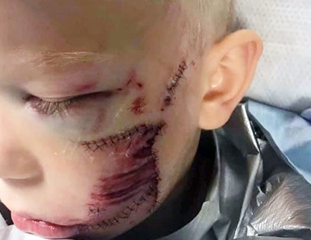 셰퍼드 혼종에 물린 소년은 2시간의 수술 동안 90바늘을 꿰맸다./사진=니키 워커 인스타그램