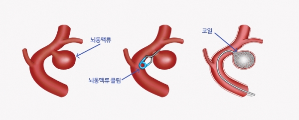 출처: 삼성서울병원 뇌졸증센터, 클립결찰술과 코일색전술