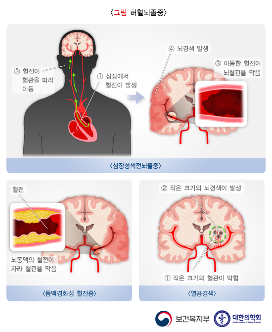 출처: 보건복지부/대한의학회, 혈전에 의한 뇌졸중 발생