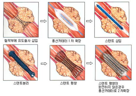 출처: 삼성서울병원 암교육센터, 스텐트 시술