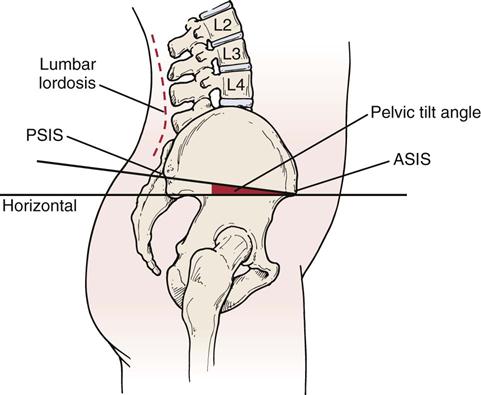 ASISS, PSIS 각도/사진제공=clinicalgate