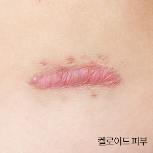 켈로이드 피부/사진=게티이미지뱅크