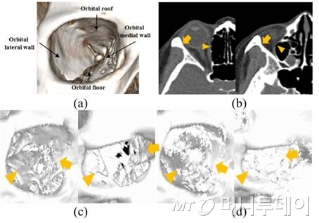 AI기반 의료영상 분할처리로 기존에는 어려웠던 얇은 뼈조직을 분할해 처리할 수 있다./사진=ETRI