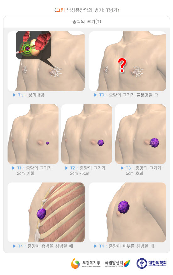 남성 유방암의 예시. (출처:보건복지부)