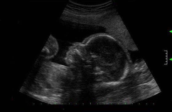 태아 초음파 사진 [중앙포토]