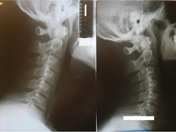 왼쪽이 일자목 상태의 경추 X-ray고, 오른쪽이 추나치료 후 정상적으로 치료된 경추 X-ray 사진이다. 오른쪽 사진처럼 앞쪽으로 C 커브를 그려야 정상이다. 이렇게 치료되려면 한의사와 환자 모두 상당한 노력이 필요하다. [사진 박용환]