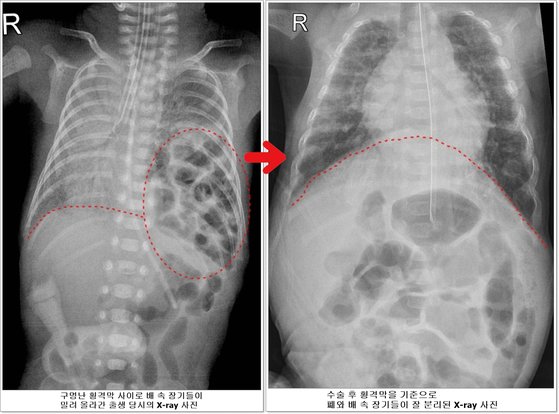 구멍난 횡격막 사이로 배 속 장기들이 밀려 올라간 출생 당시의 X-ray 사진(왼쪽)과 수술 후 횡격막을 기준으로 폐와 배 속 장기들이 잘 분리된 X-ray 사진 [서울아산병원]
