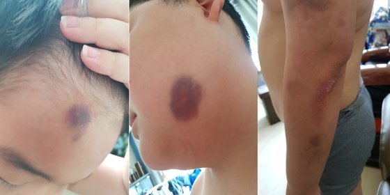 지난 6월 대전에서 친구들에게 폭행과 괴롭힘을 당해 온 몸에 멍이 든 중학생의 모습. 학부모는 가해 학생을 처벌해달라며 경찰에 신고했다. [사진 학부모]