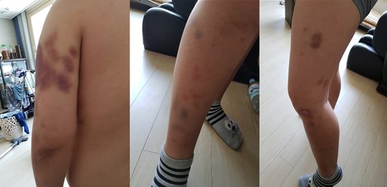 지난 6월 대전에서 친구들에게 폭행과 괴롭힘을 당해 온 몸에 멍이 든 중학생의 모습. 학부모는 가해 학생을 처벌해달라며 경찰에 신고했다. [사진 학부모]