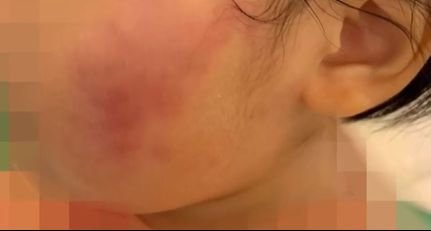 어린이집 원장으로부터 뺨 등을 폭행당한 3살 원아의 상처. JTBC 화면 캡처