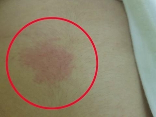 한 문래동 주민은 수돗물 이용 후 피부병이 발생했다고 말했다. /주민 제공