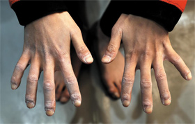 일곱 살 때부터 시작… 10년 경력의 흔적 - 굳은살이 박인 서채현의 손. 암벽 등반 10년 경력의 흔적이 손발에 고스란히 새겨졌다. /이진한 기자