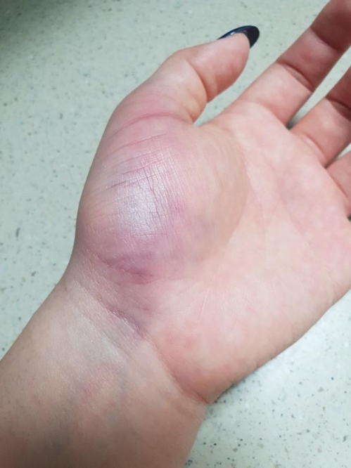 훌라우프로 맞아 멍이든 A씨 손[A씨 제공]