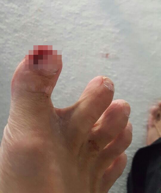 조현아 전 대한항공 부사장의 남편 박 모씨가 공개한 2016년 9월 조 전 부사장의 폭행 흔적. 박 씨는 조 전 부사장이 던진 태블렛PC에 맞아 오른쪽 엄지발가락 일부가 절단됐다고 주장했다. 남편 박모씨 제공