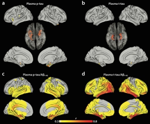 혈중 인산화 타우농도, 전체 타우 농도, 베타 아밀로이드 농도를 측정해 분석한 결과 혈중 전체 타우농도/베타 아밀로이드 농도의 비율이 뇌 타우 축적과 가장 밀접한 연관성이 있음을 나타내는 그림. (a)혈중 인산화 타우만으로 예측한 결과 (b)전체 타우로 예측한 결과 (c)인산화타우/베타 아밀로이드 농도로 예측한 결과 (d)전체 타우/베타 아밀로이드로 예측한 결과. [과학기술정보통신부 제공]