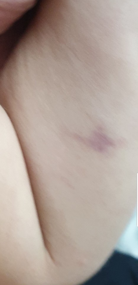 아이의 팔뚝 부위에도 손톱으로 꼬집은 상처가 있다. CCTV로 확인한 결과 담임선생님은 아이의 뒤통수, 앞머리, 팔 등을 때렸다. [피해부모 제공]