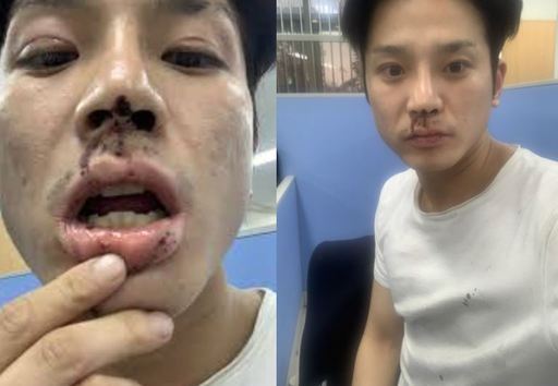 김상교씨가지난해 12월 자신의 SNS에 버닝썬의 보안요원과 이후 출동한 역삼지구대 경찰들에게 폭행을 당했다고 주장하며 직접 게재한 사진. 김상교 SNS.