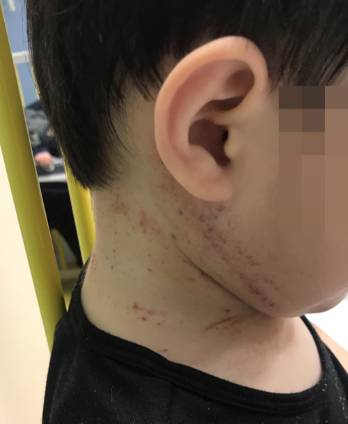 C씨의 19개월 된 자녀가 특발성혈소판감소성자반증(ITP) 발병으로 피부에 점상 출혈이 나타난 모습. C씨 제공