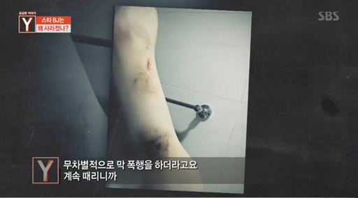 18일 방송된 SBS ‘궁금한 이야기 Y’에서 ‘스타 BJ’ A씨의 전 여자친구 C씨가가 A씨의 폭행으로 부상당한 신체를 공개했다. SBS ‘궁금한 이야기 Y’ 캡처