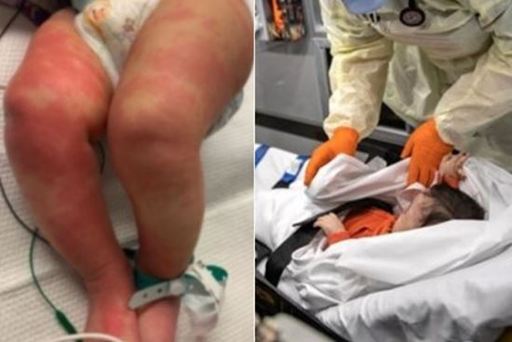 신종 코로나바이러스 감염증(코로나19)과 연관된 것으로 추정되는 이른바 ‘어린이 괴질’ 사례가 국내에서도 나왔다. 트위터, 연합뉴스