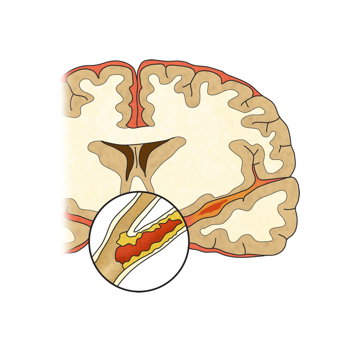 후유증 뇌경색 뇌경색의 증상과