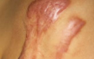 치료 힘든 켈로이드 피부 흉터, 수술·방사선 요법 치료로 완치 치료 힘든 켈로이드 피부 흉터, 수술·방사선 요법 치료로 완치