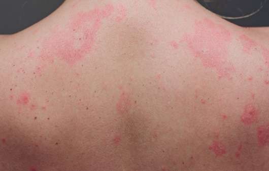 알레르기성 두드러기의 가려움증이 있는 피부 문제는 뉴스 아이템에 맡겨주세요:) 알레르기성 두드러기의 가려움증이 있는 피부 문제는 뉴스 아이템에 맡겨주세요:)